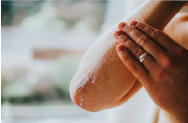 ماذا يحدث للجلد أثناء علاج السرطان؟